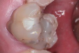 Cerec-Before-1