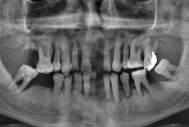 Dental-Implants-Before