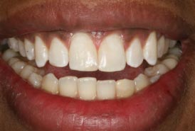 Diastema-closure-after