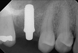 Zirconia-Implant-after