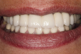 fullmouth_crowns_after