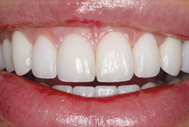 Crown-Lengthening-Porcelain-Veneers-after