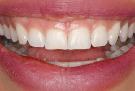 Crown-Lengthening-Porcelain-Veneers-before (1)